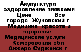 Акупунктура, оздоровление пиявками › Цена ­ 3 000 - Все города, Жуковский г. Медицина, красота и здоровье » Медицинские услуги   . Кемеровская обл.,Анжеро-Судженск г.